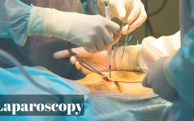 Laproscopy Eraya Fertility